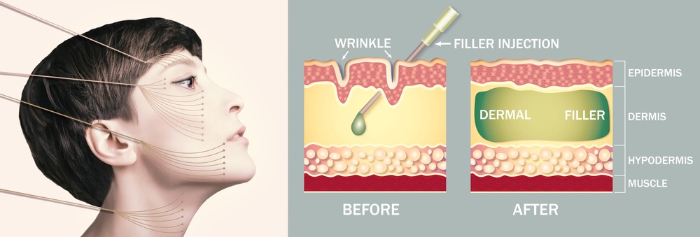 dermal-filler, mack-filler, mack-skin, korean-filler